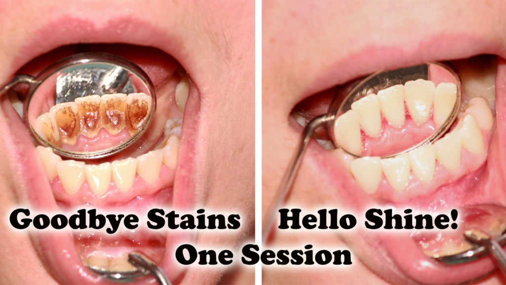 A before-and-after comparison of teeth cleaning. The left side shows heavily stained teeth, viewed through a dental mirror. The right side shows the same teeth, now clean and white, also viewed through a dental mirror. Text reads, "Goodbye Stains, One Session" and "Hello Shine!.