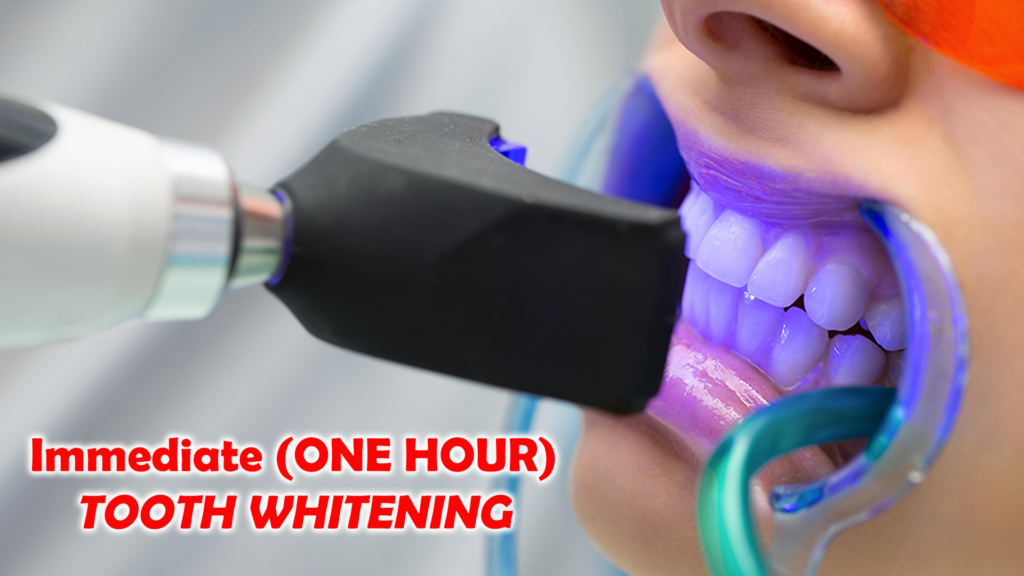 Close-up of a person's mouth undergoing a tooth whitening procedure with a dental tool emitting a blue light. The person is wearing protective orange goggles. Text on the image reads, "Immediate (ONE HOUR) TOOTH WHITENING" in bold red letters.